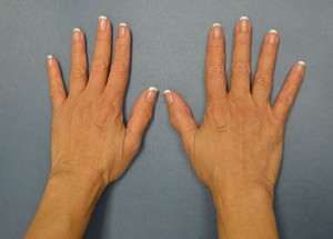 Hand Rejuvenation Case 3304 Before Photo Hand Rejuvenation