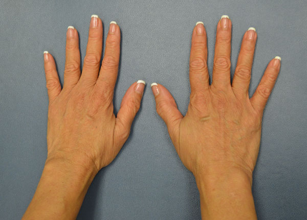 Hand Rejuvenation