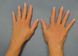 Hand Rejuvenation Case 3304 After Photo Hand Rejuvenation