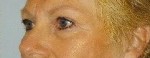 Blepharoplasty