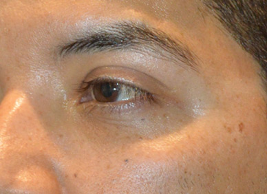 Blepharoplasty