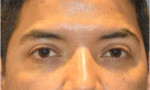 Blepharoplasty