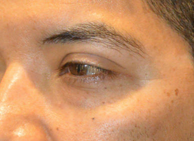 Blepharoplasty