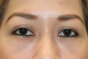Fillers and Injectables