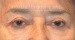 Blepharoplasty