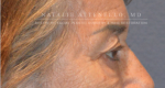 Blepharoplasty