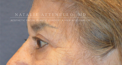 Blepharoplasty