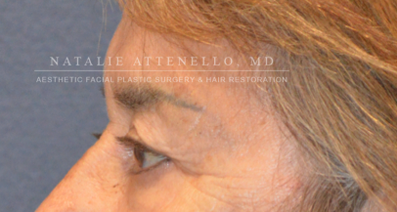 Blepharoplasty