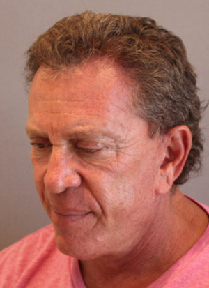 Hair Restoration Case 3453 After Photo Hair Restoration