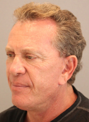 Hair Restoration Case 3453 Before Photo Hair Restoration