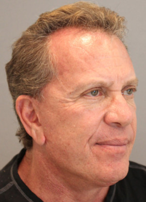Hair Restoration Case 3453 Before Photo Hair Restoration