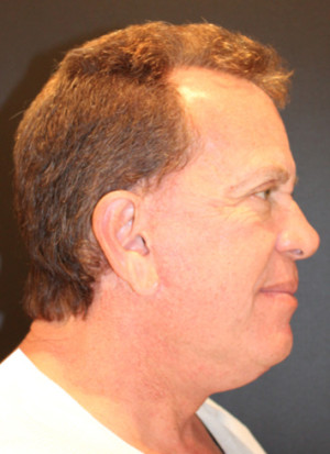 Hair Restoration Case 3453 Before Photo Hair Restoration