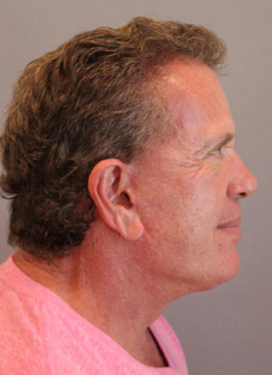 Hair Restoration Case 3453 After Photo Hair Restoration