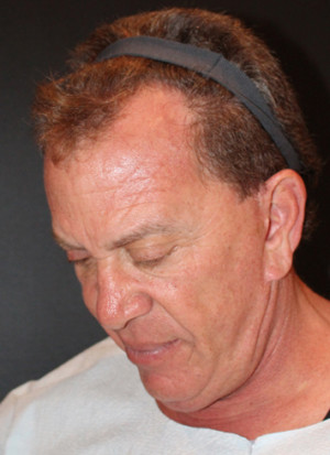 Hair Restoration Case 3453 Before Photo Hair Restoration