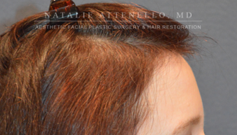 Hair Restoration