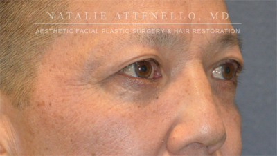 Blepharoplasty