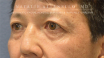 Blepharoplasty