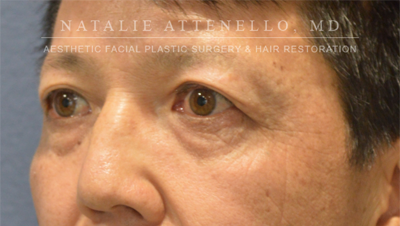 Blepharoplasty