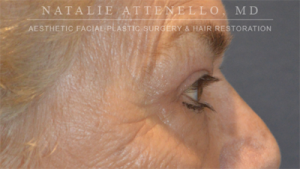 Blepharoplasty Case 3510 After Photo Blepharoplasty
