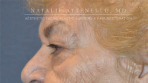 Blepharoplasty Case 3510 Before Photo Blepharoplasty