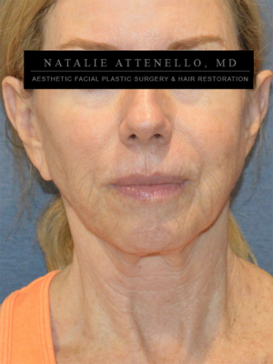 Facelift Case 3525 Before Photo Facelift