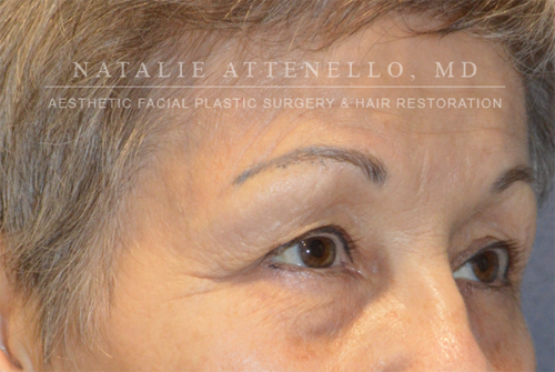 Blepharoplasty