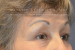 Blepharoplasty