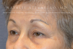 Blepharoplasty