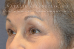 Blepharoplasty