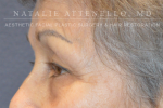 Blepharoplasty