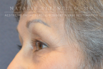 Blepharoplasty