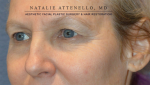 Blepharoplasty