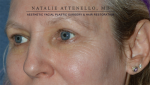 Blepharoplasty