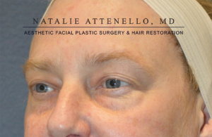 Blepharoplasty Case 3552 Before Photo Blepharoplasty