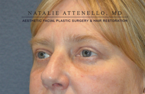 Blepharoplasty Case 3552 After Photo Blepharoplasty