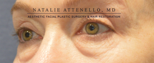 Blepharoplasty