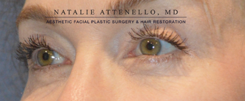 Blepharoplasty