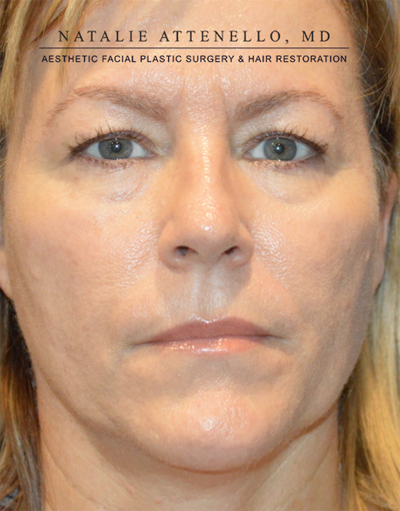 Blepharoplasty