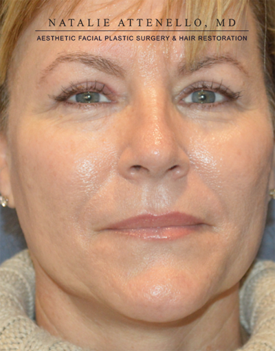 Blepharoplasty