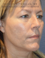 Blepharoplasty