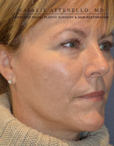 Blepharoplasty