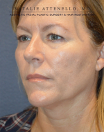 Blepharoplasty