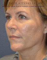 Blepharoplasty