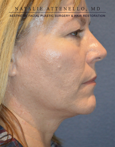 Blepharoplasty