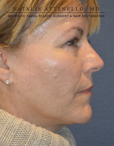 Blepharoplasty