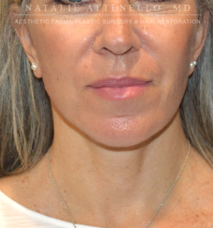 Facelift Case 3591 After Photo Facelift