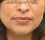 Fillers and Injectables