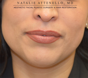 Fillers and Injectables