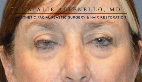 Blepharoplasty