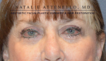 Blepharoplasty